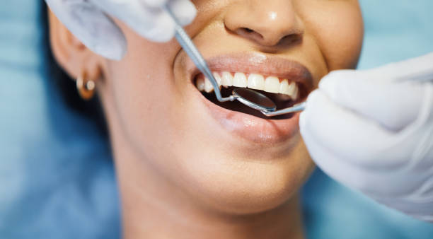 Best Knocked-Out Tooth (Avulsed Tooth) Treatment in Milford, DE