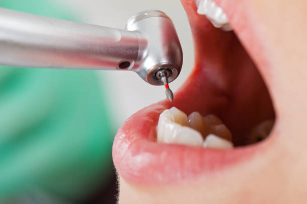 Best Emergency Root Canal Therapy in Milford, DE
